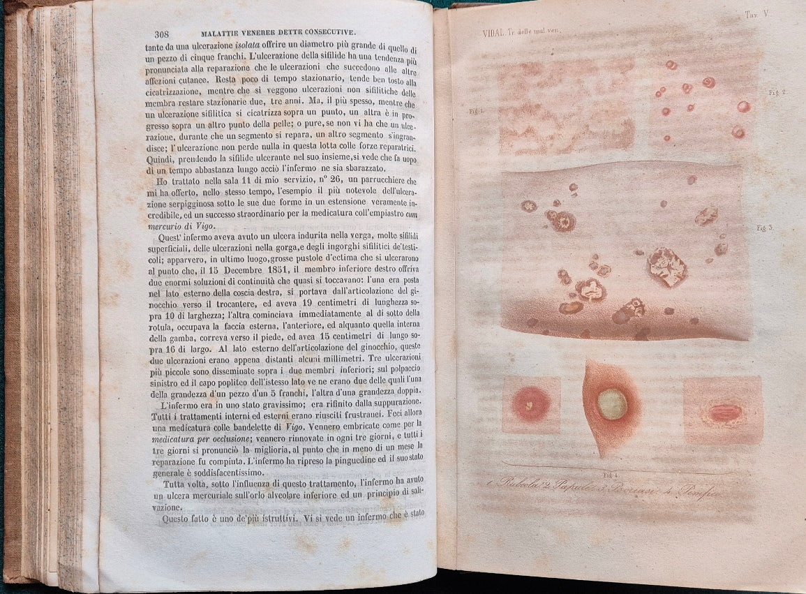 Trattato delle malattie veneree