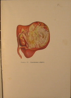 Kidney tumors